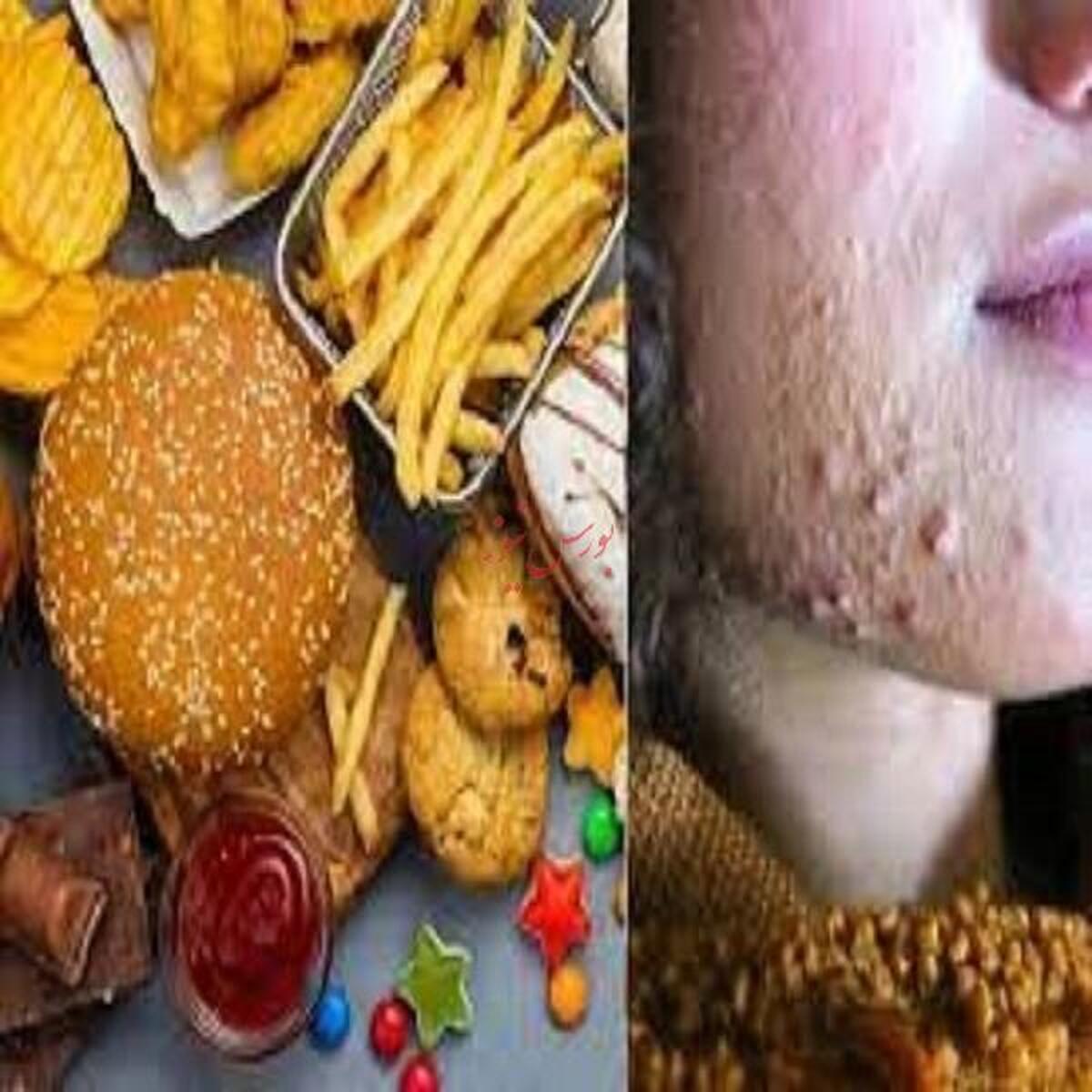 چگونه با رژیم غذایی جوش‌های خود را درمان کنیم؟