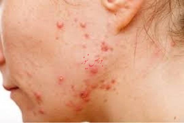 چگونه با رژیم غذایی جوش‌های خود را درمان کنیم؟